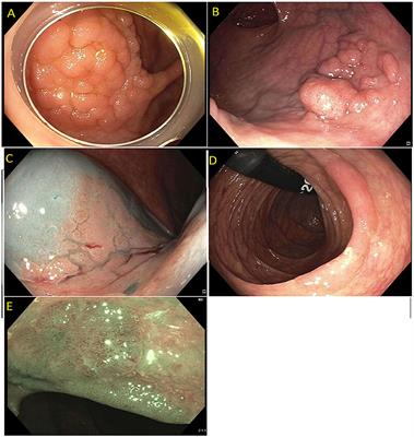 Endoscopic Management of Complex Colorectal Polyps: Current Insights and Future Trends